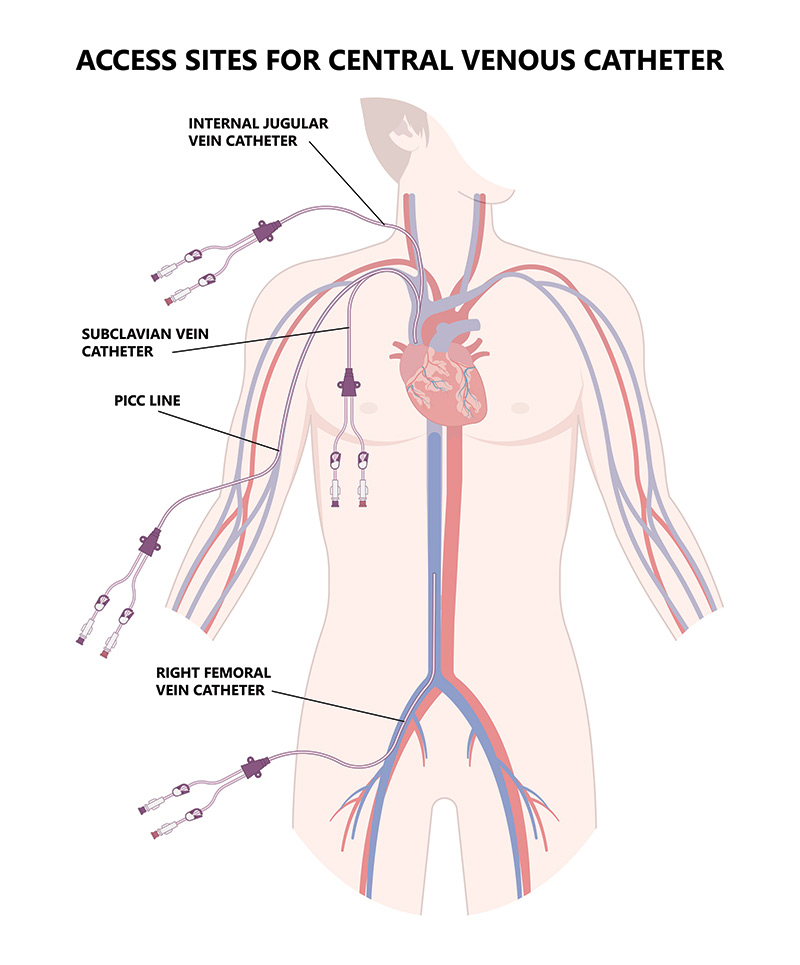 Access Sites for Central Venous Catheter