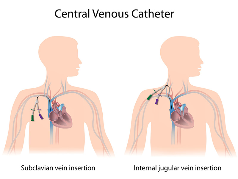 Temporary Central Venous Line