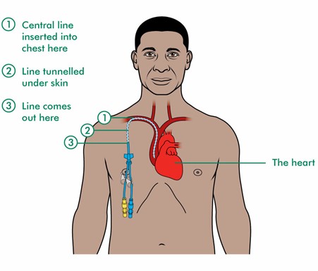 Tunnelled central venous line